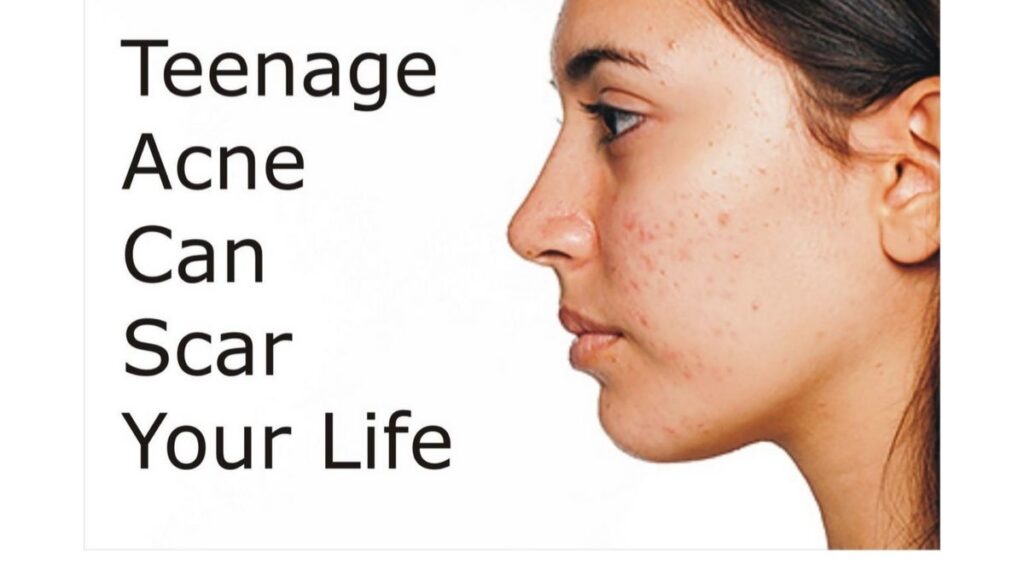 Teen girl applying pimple cream on face,  best treatment for teenage acne: Teenage Pimples Best Treatments